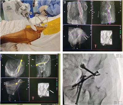 Surgical robot-assisted tripod percutaneous reconstruction technique combined with bone cement filling technique for the treatment of acetabular metastasis